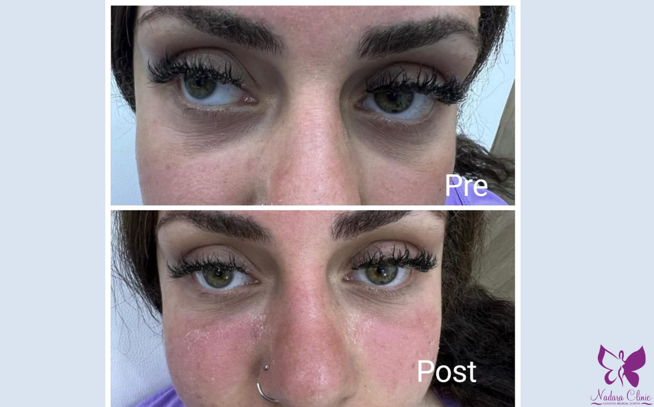 Filler to treat dark circles